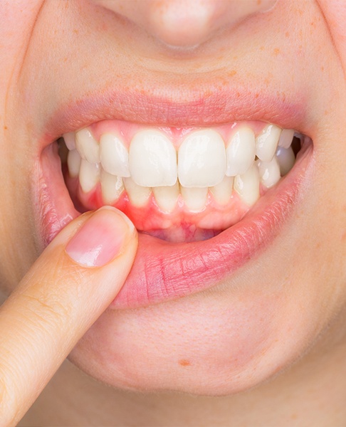 Person pointing to their inflamed gum tissue