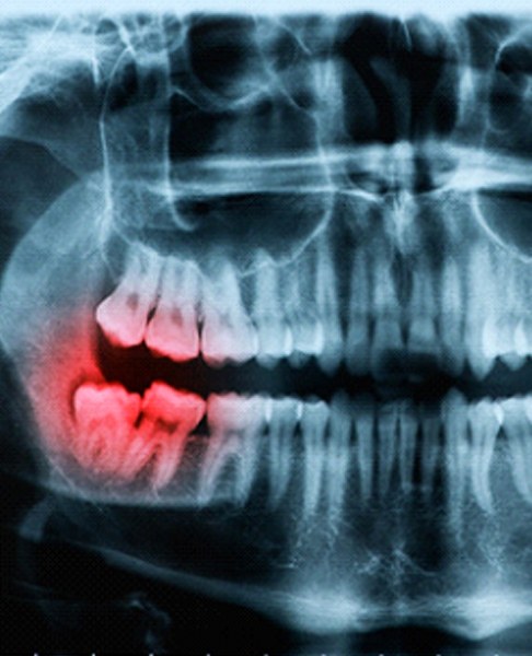 X ray of a person's teeth with the wisdom teeth highlighted red