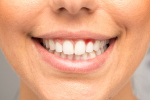 Close-up of smile with signs of gum disease