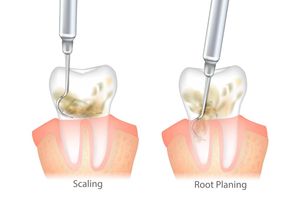 Graphic of scaling & root planing