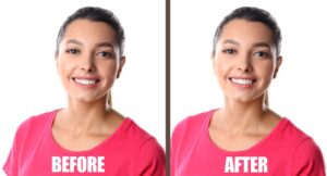 Portrait of woman before and after gum recontouring 