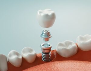 Animated rendering of dental implant. 