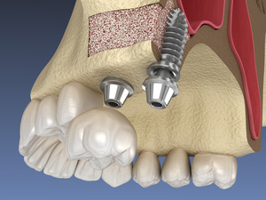 Illustration of dental implants placed after a sinus lift