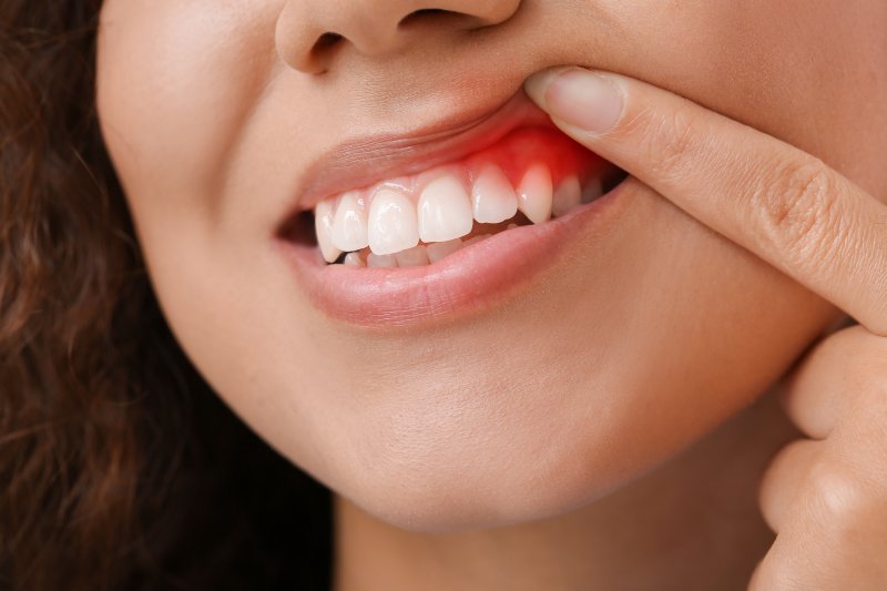 A young woman revealing her inflamed gums