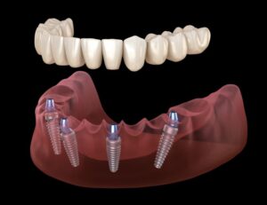 Illustration of All-on-4 dental implants against dark background
