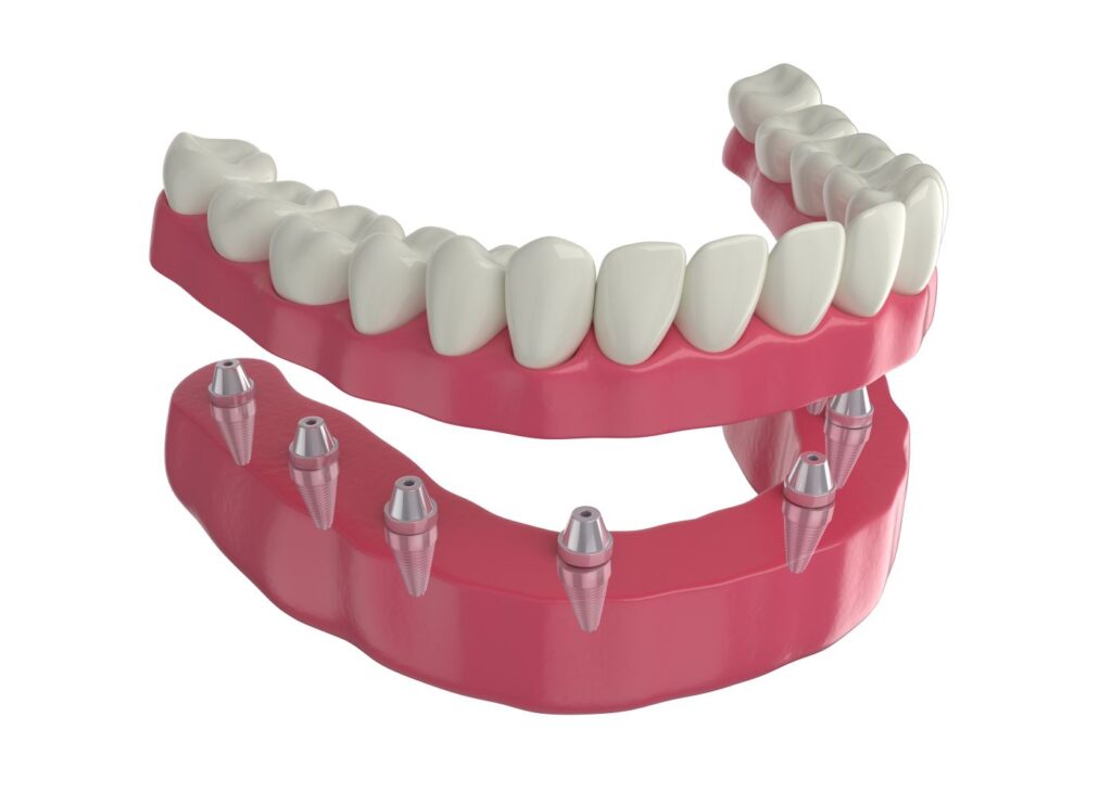 A CGI of implant dentures and how they attach to the jawbone.