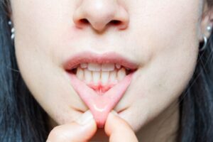 Woman showing receding gums.