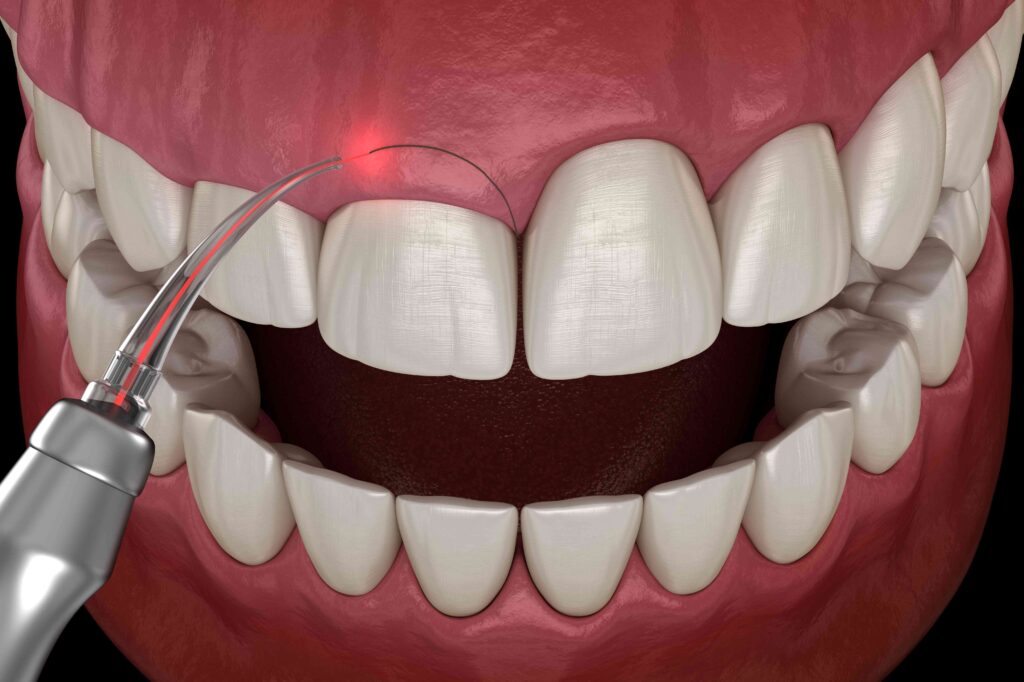 Illustration of gum recontouring