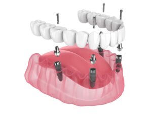 All-on-4 dental implants.