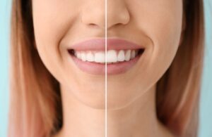Woman’s smile before and after esthetic gingival recontouring